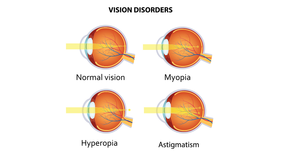 vision disorders myopia, hyperopia, astigmatism, contact lenses v's spectacles, Oodo™