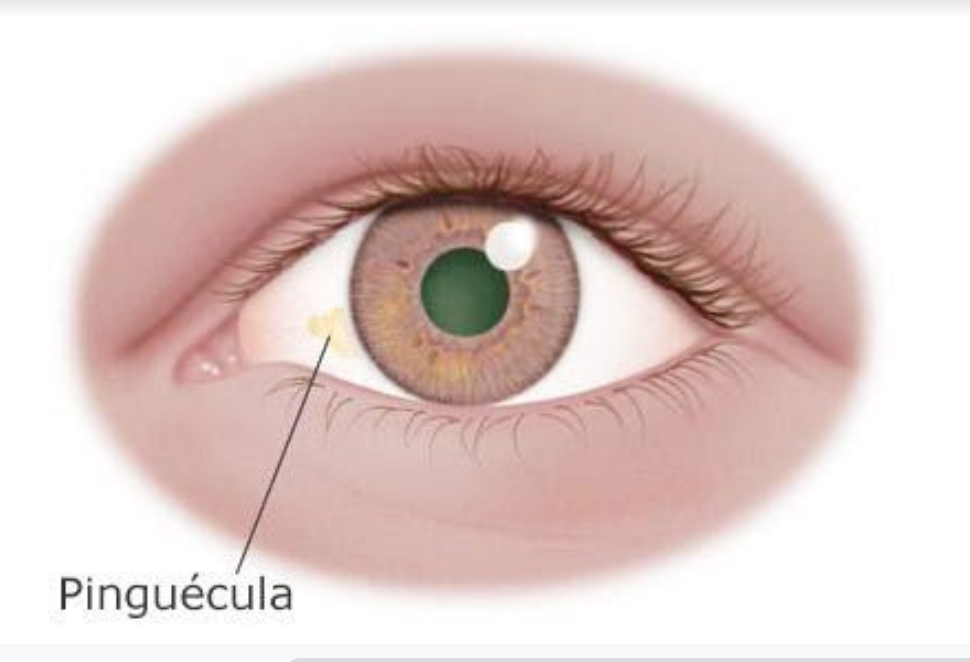 Pinguecula, dry eyes, UV exposure, Oodo™