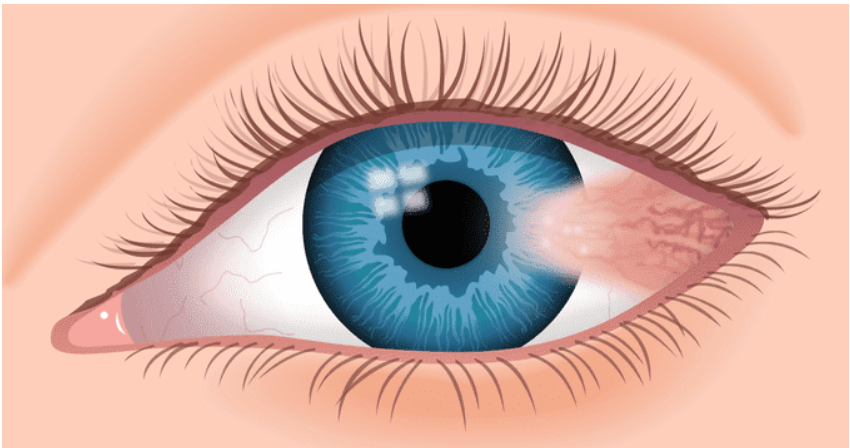 Pterygium, dry eyes, UV exposure, Oodo™