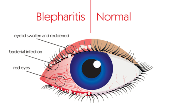 bleparitis eye infection, dry eyes, MGD, Oodo™