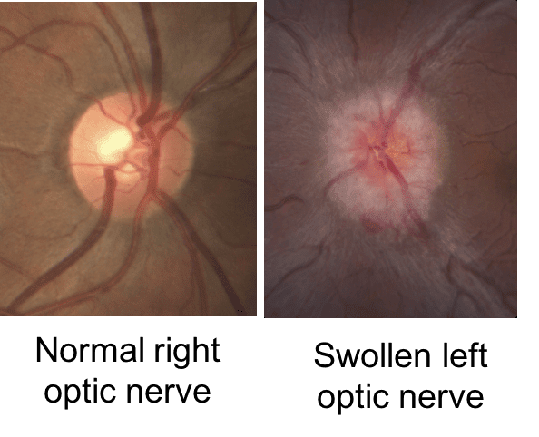 optic nerve cancer or tumour, opticians, sight test, Oodo™