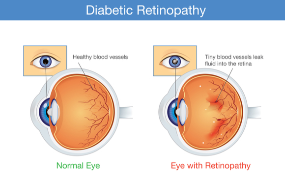 diabetic retinopathy, retina, sight test, eye exam, opticians, Oodo™