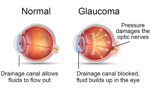 Glaucoma, optic nerve, sight test, eye exam, opticians, Oodo™