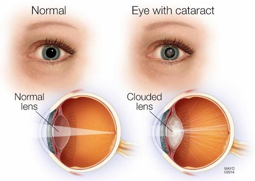 normal eye and cataract, eye exam, sight test, opticians, Oodo™