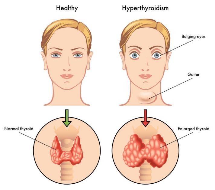 thyroid disease, Opticians, Eye exam, sight test, Oodo™